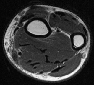 Figure 5 for case Flexor carpi radialis tendon laceration ( RID2388 )